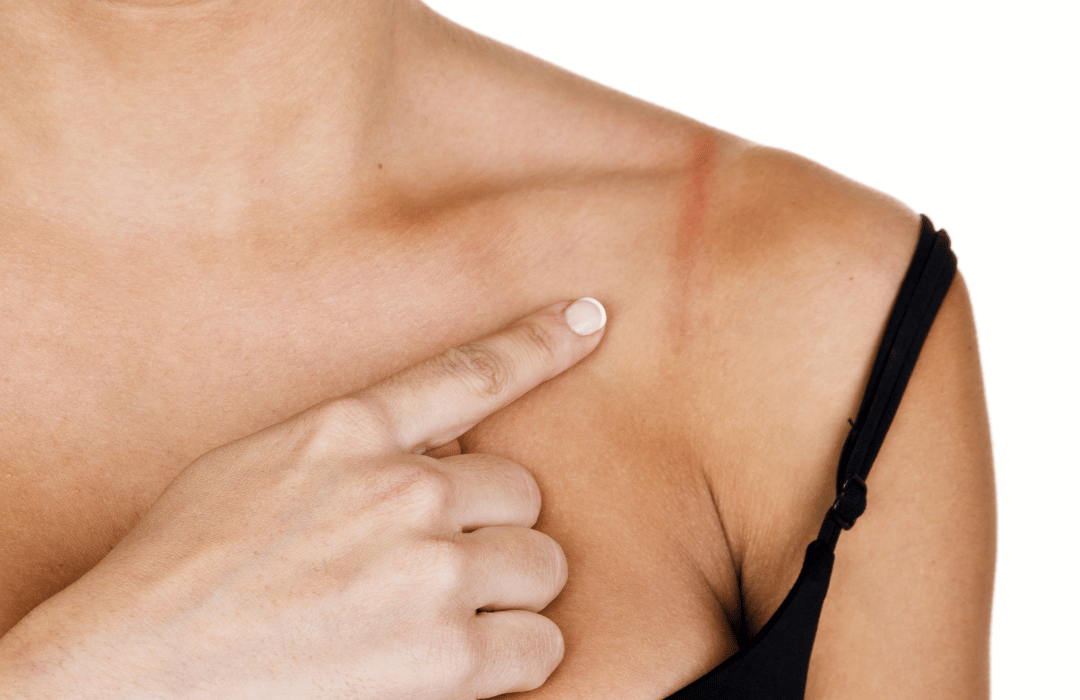 Schoudervullingen van Shapetape